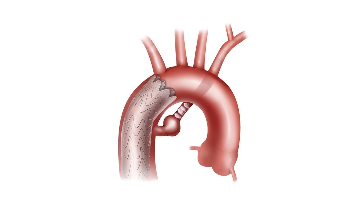 Ilustração de aorta com endoprótese implantada para tratamento de aneurisma