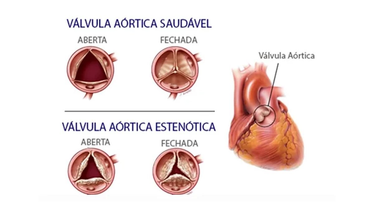 Comparação entre válvula aórtica saudável e válvula aórtica estenótica, aberta e fechada