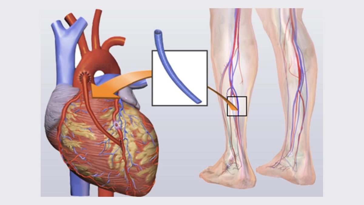 Ilustração da cirurgia de ponte de safena, com enxerto da veia safena da perna para o coração